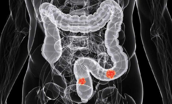 cancer colon symptomes negi genitale moluscul